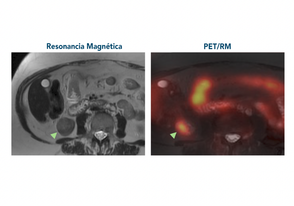 Cetir Ascires, pioner a Espanya en una tècnica que permet evitar cirurgies innecessàries en tumors renals